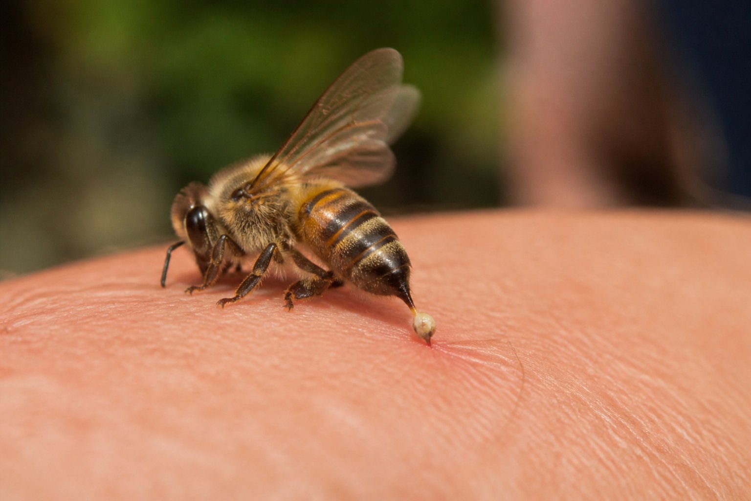 Close-up of a honeybee stinging human skin with its stinger embedded, showing the bee in a lifeless state.