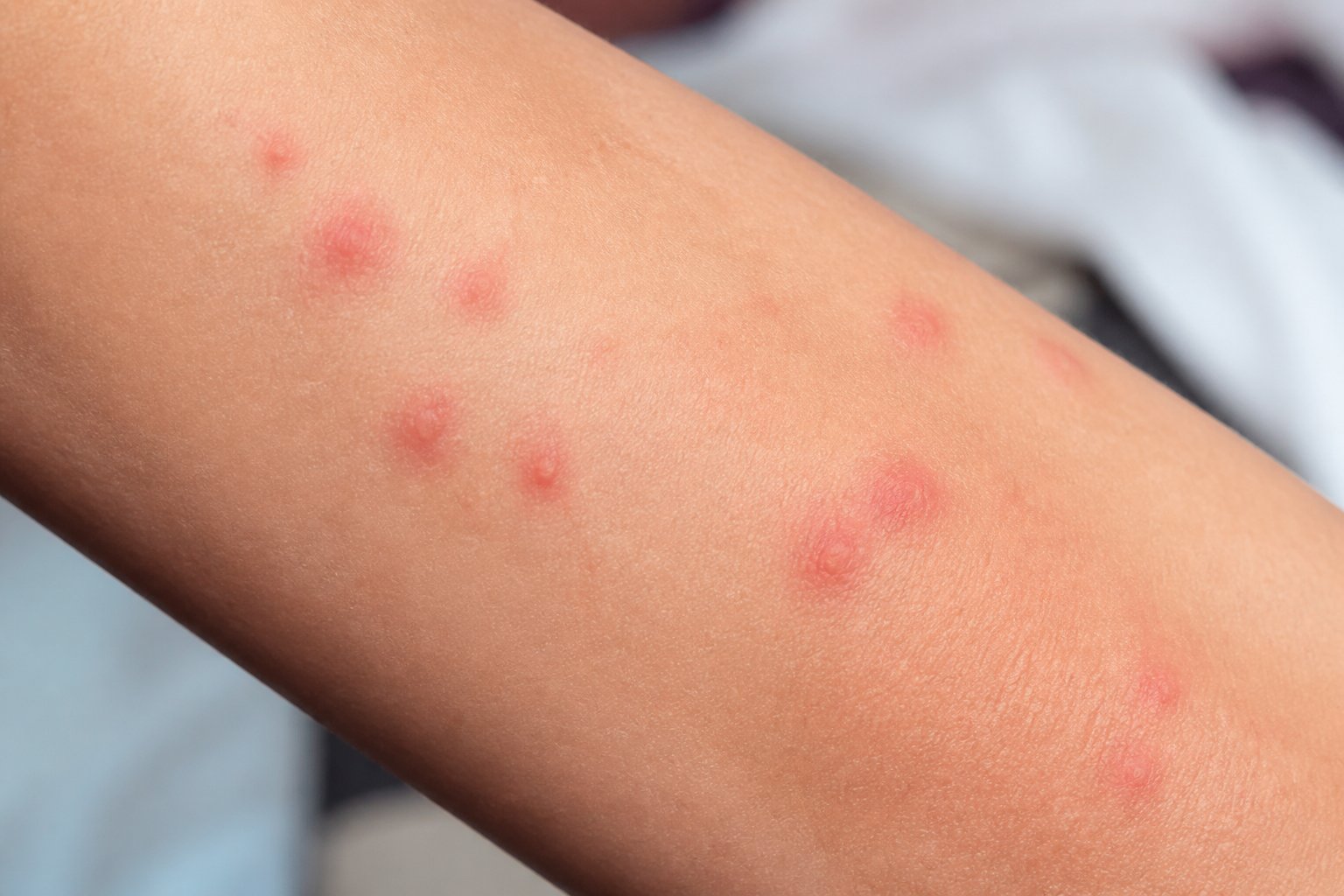 Close-up of human skin showing several small red bed bug bites clustered together.