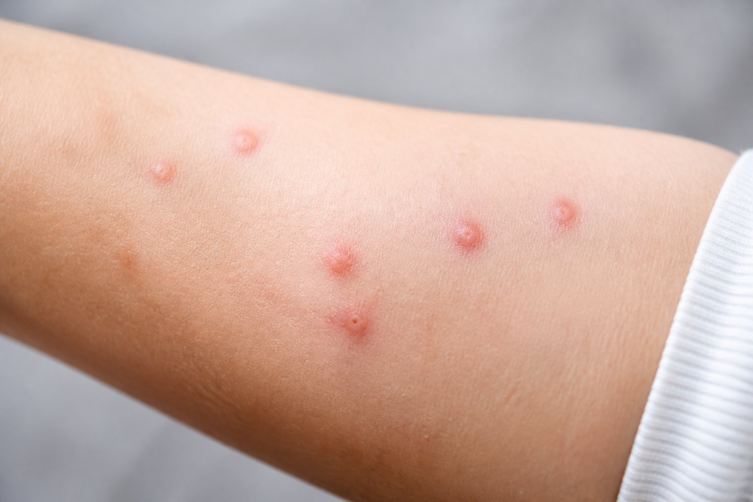 Close-up of a person's arm with red, raised insect bites and mild swelling.