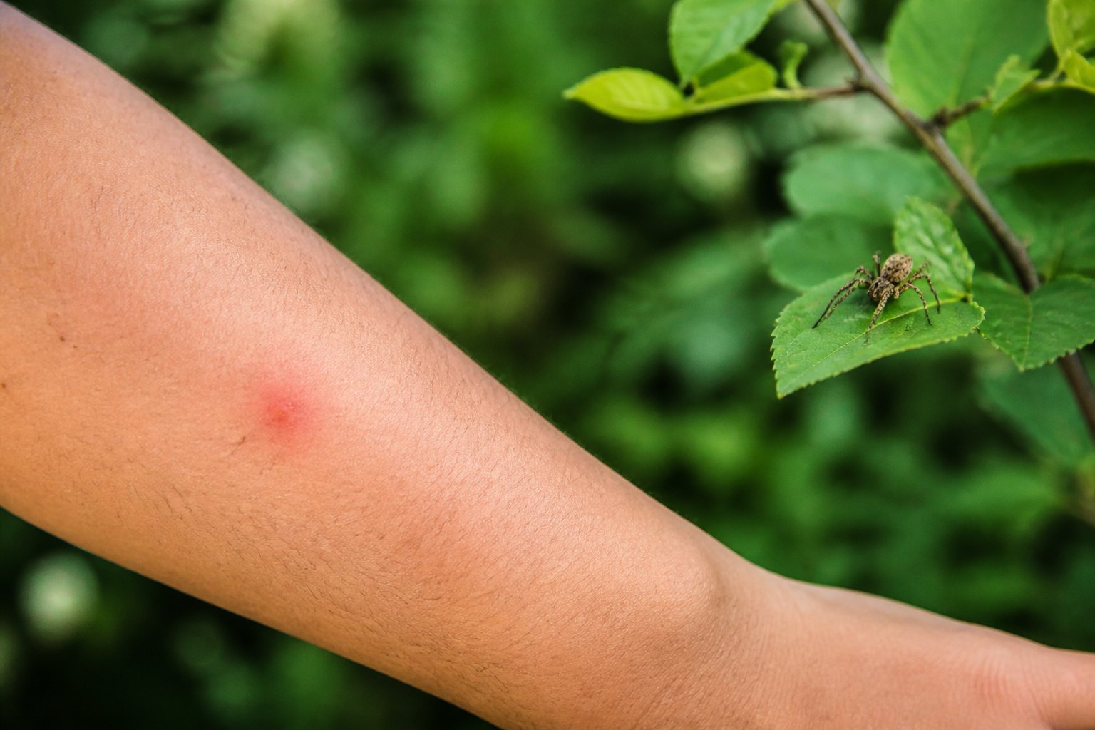 Close-up of a person's arm with a small red bite mark and a spider on a nearby leaf in a natural outdoor setting.