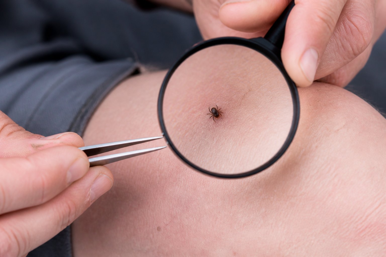 A small tick attached to a person’s forearm while the skin is being examined.